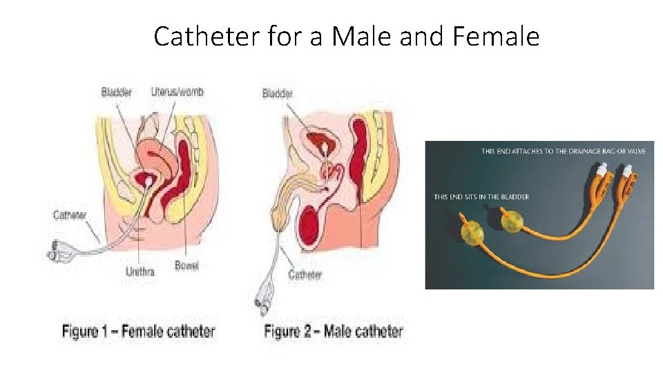 Catheter for a Male and Female 