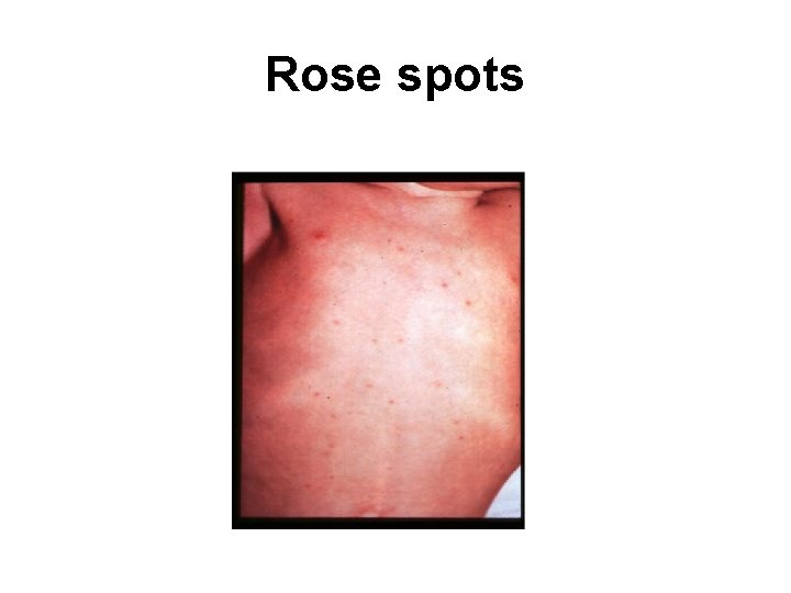 Rose spots 