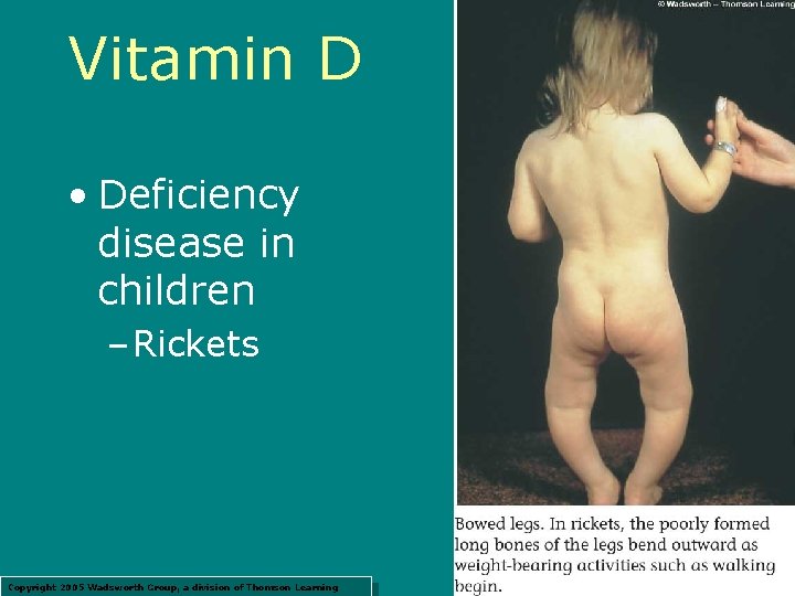 Vitamin D • Deficiency disease in children – Rickets Copyright 2005 Wadsworth Group, a