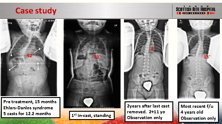 Case study 5° 52° Pre treatment, 15 months Ehlers-Danlos syndrome 5 casts for 12.