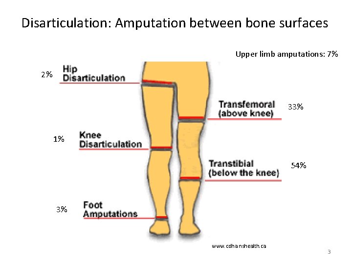 Disarticulation: Amputation between bone surfaces Upper limb amputations: 7% 2% 33% 1% 54% 3%