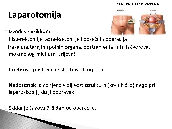 Slika 1. kirurški zahvat-laparatomija Laparotomija � Izvodi se prilikom: � histerektomije, adneksetomije i opsežnih