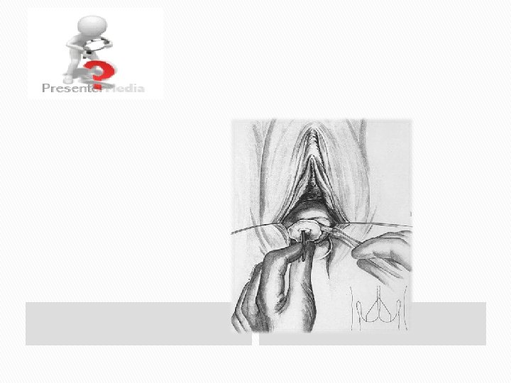 � Slika 5. vaginalna operacija 