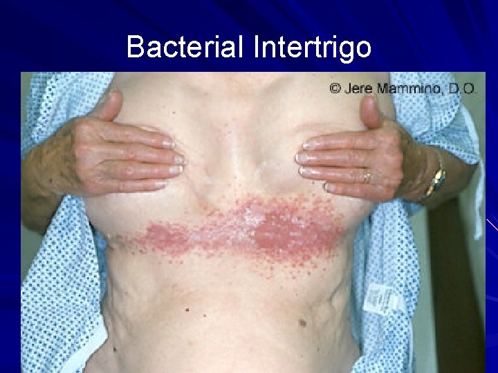 Bacterial Intertrigo 