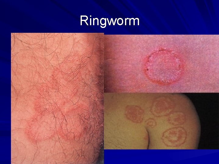 Ringworm 