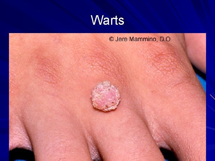 Warts 