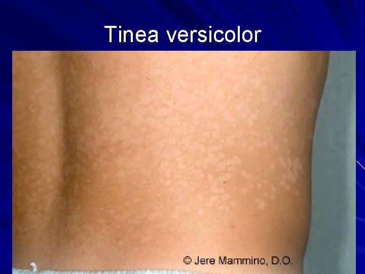 Tinea versicolor 