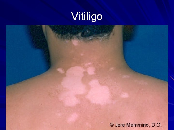 Vitiligo 