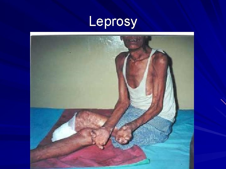 Leprosy 