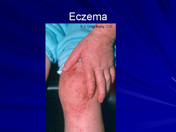 Eczema 