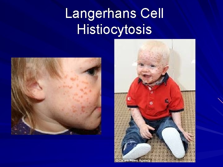 Langerhans Cell Histiocytosis 