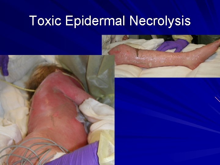 Toxic Epidermal Necrolysis 