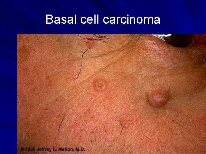 Basal cell carcinoma 