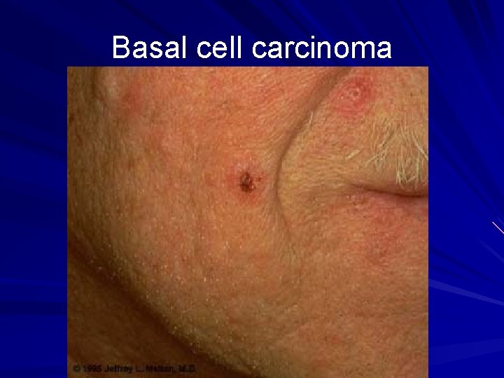 Basal cell carcinoma 