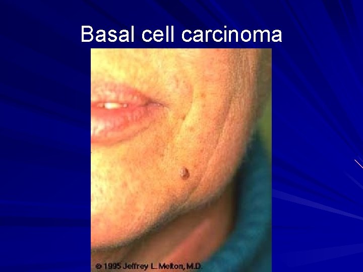 Basal cell carcinoma 