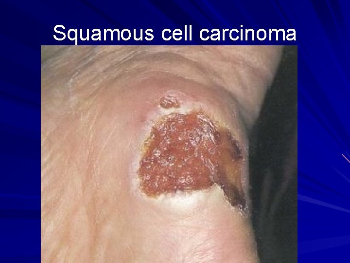 Squamous cell carcinoma 