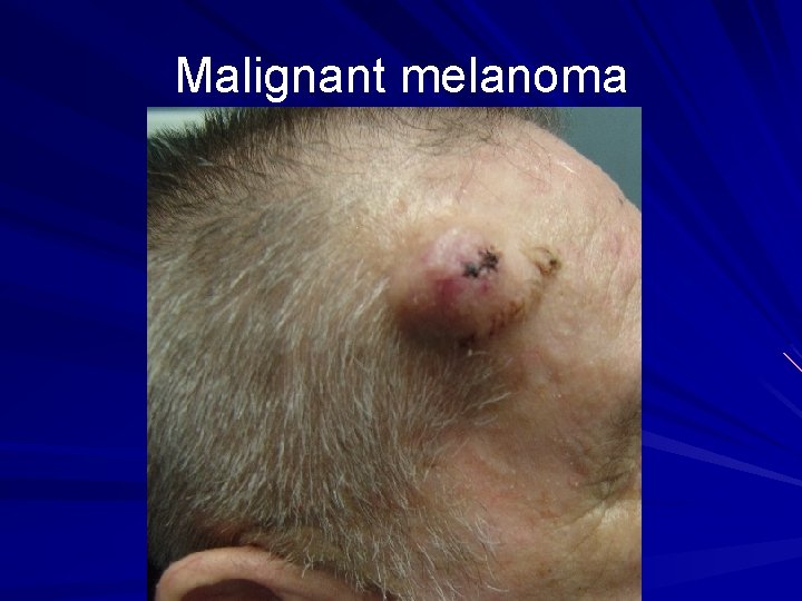 Malignant melanoma 