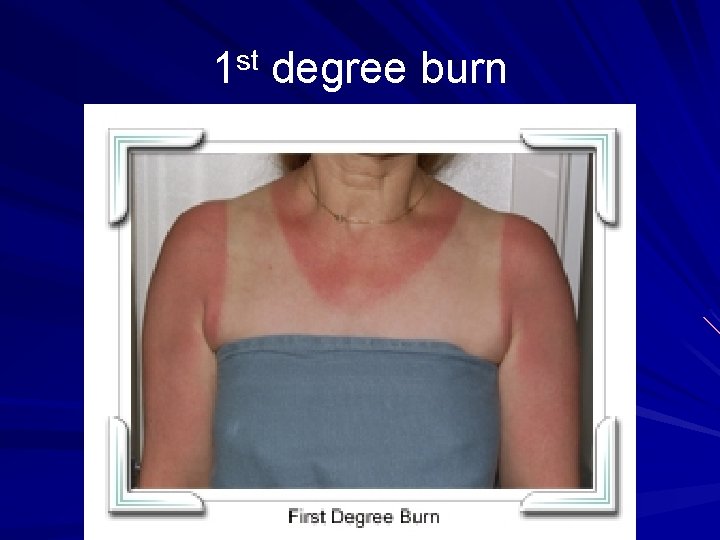 1 st degree burn 