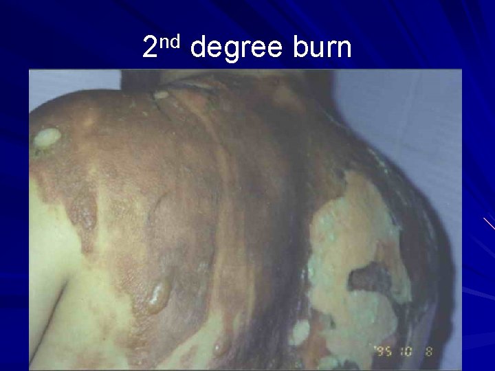 2 nd degree burn 