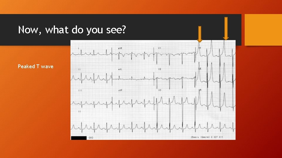 Now, what do you see? Peaked T wave 