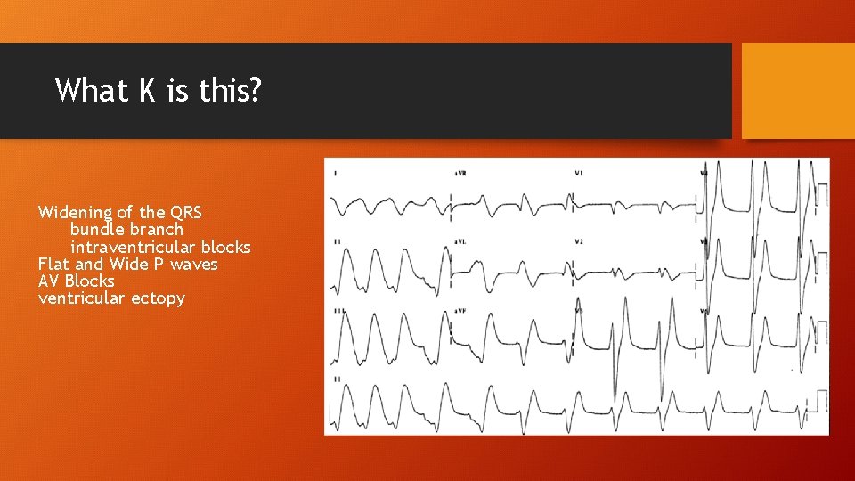 What K is this? Widening of the QRS bundle branch intraventricular blocks Flat and