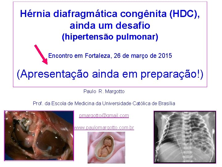 Hérnia diafragmática congênita (HDC), ainda um desafio (hipertensão pulmonar) Encontro em Fortaleza, 26 de