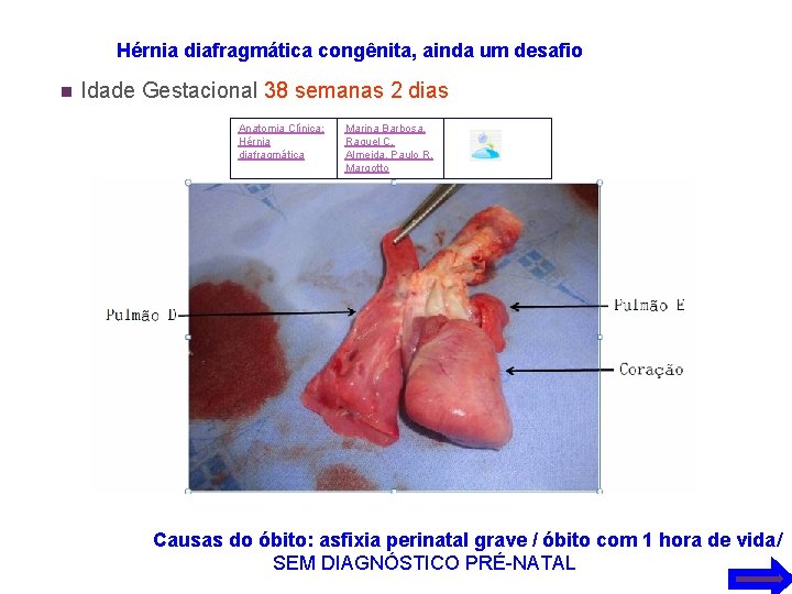 Hérnia diafragmática congênita, ainda um desafio n Idade Gestacional 38 semanas 2 dias Anatomia