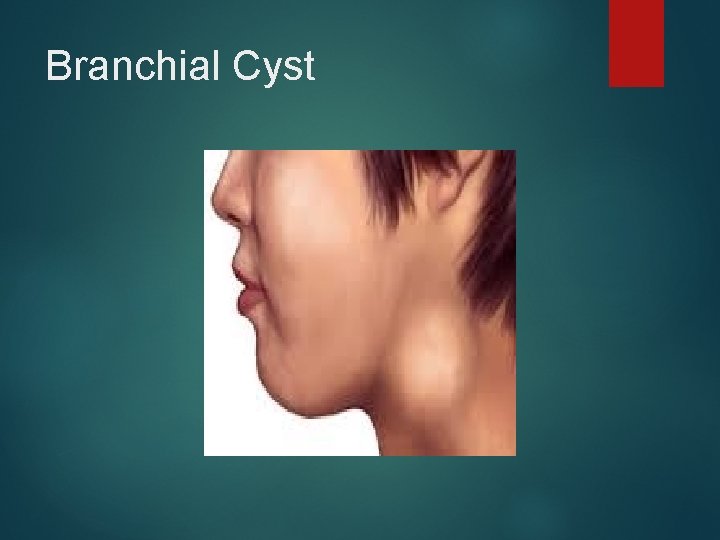 Branchial Cyst 