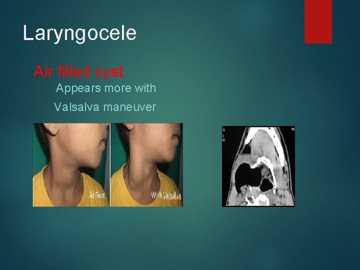 Laryngocele Air filled cyst Appears more with Valsalva maneuver 