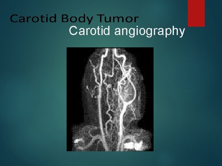 Carotid angiography 