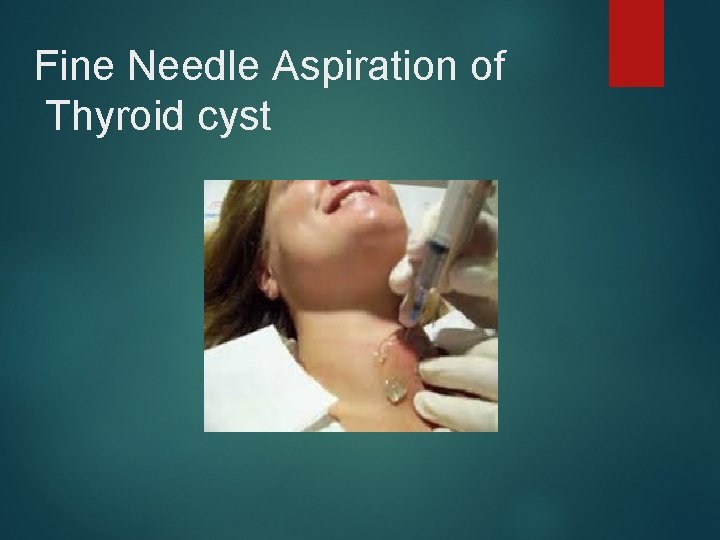 Fine Needle Aspiration of Thyroid cyst 