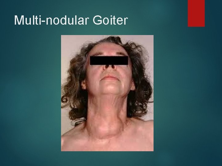 Multi-nodular Goiter 