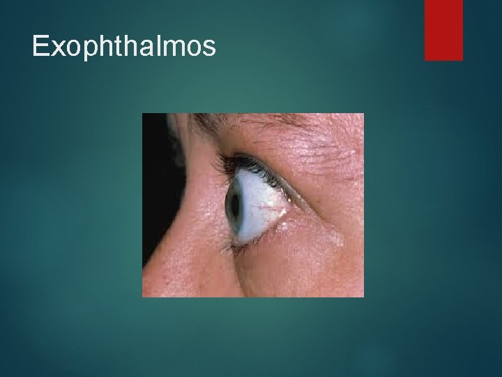Exophthalmos 