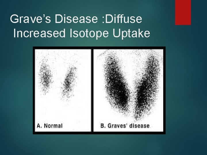 Grave’s Disease : Diffuse Increased Isotope Uptake 