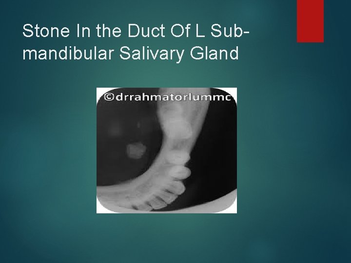 Stone In the Duct Of L Submandibular Salivary Gland 