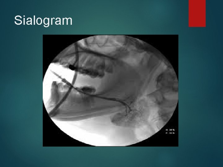 Sialogram 