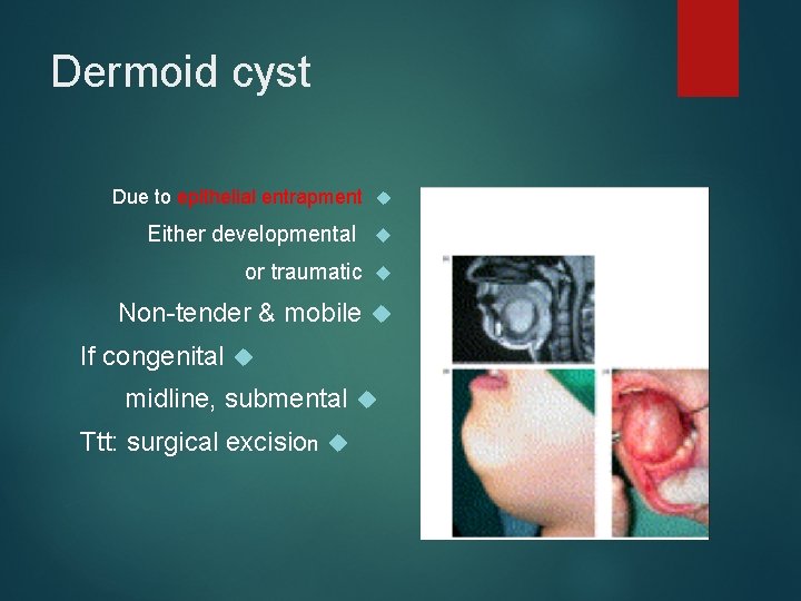 Dermoid cyst Due to epithelial entrapment Either developmental or traumatic Non-tender & mobile If