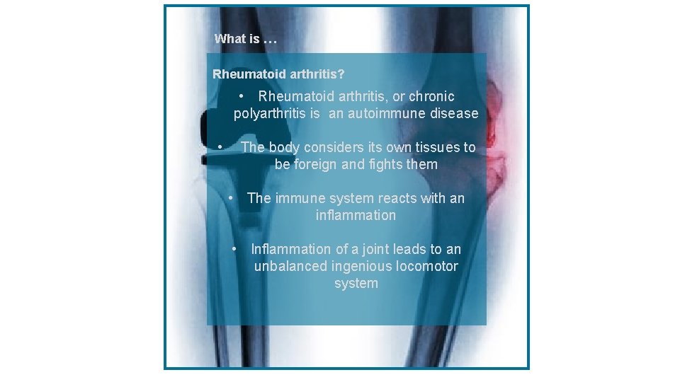 What is … Rheumatoid arthritis? • Rheumatoid arthritis, or chronic polyarthritis is an autoimmune