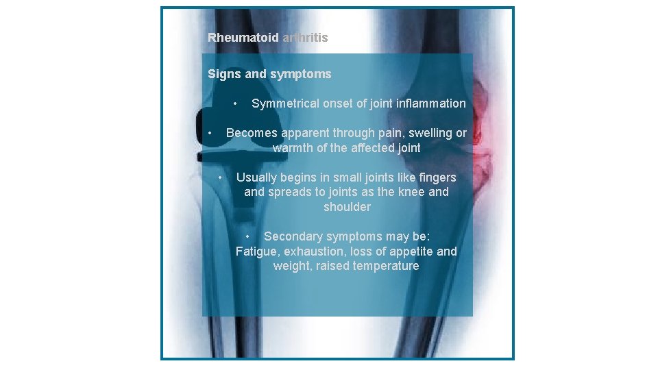 Rheumatoid arthritiss Signs and symptoms • • Symmetrical onset of joint inflammation Becomes apparent