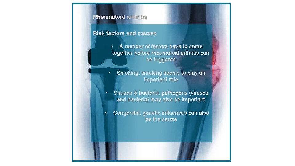 Rheumatoid arthritiss Risk factors and causes • A number of factors have to come