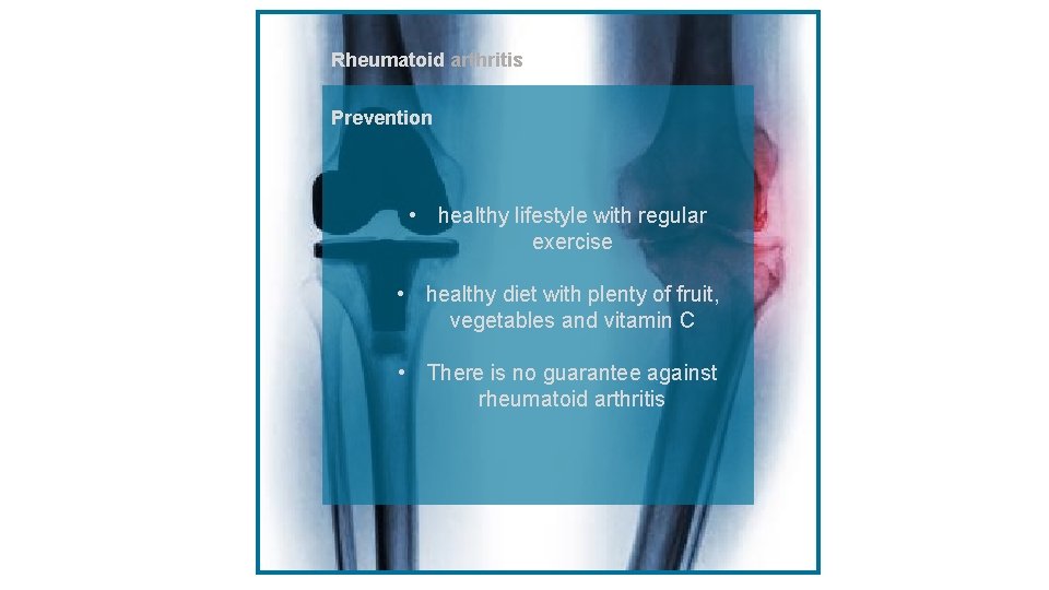 Rheumatoid arthritiss Prevention • healthy lifestyle with regular exercise • healthy diet with plenty