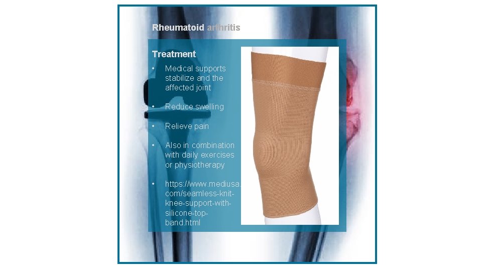 Rheumatoid arthritiss Treatment • Medical supports stabilize and the affected joint • Reduce swelling