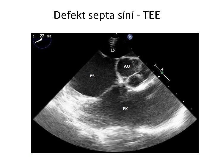 Defekt septa síní - TEE 