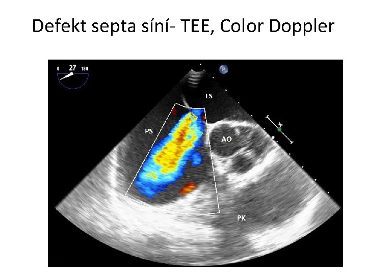 Defekt septa síní- TEE, Color Doppler 