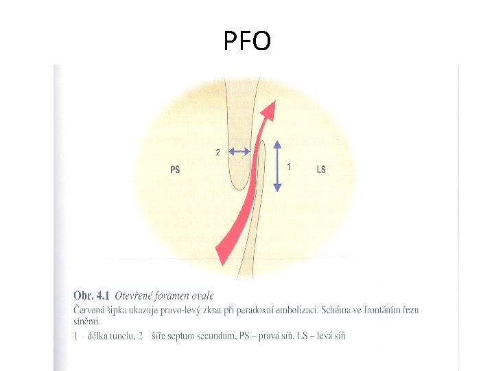 PFO 