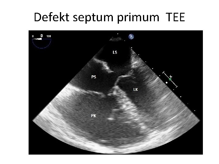 Defekt septum primum TEE 