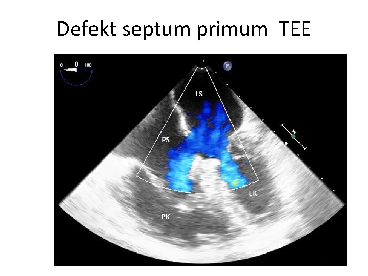 Defekt septum primum TEE 