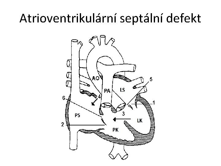 Atrioventrikulární septální defekt 