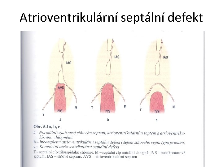 Atrioventrikulární septální defekt 