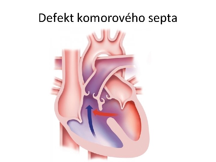 Defekt komorového septa 